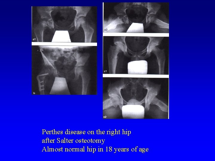 Perthes disease on the right hip after Salter osteotomy Almost normal hip in 18