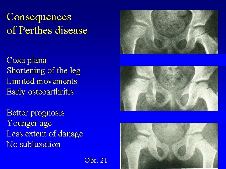 Consequences of Perthes disease Coxa plana Shortening of the leg Limited movements Early osteoarthritis