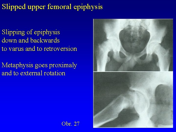 Slipped upper femoral epiphysis Slipping of epiphysis down and backwards to varus and to