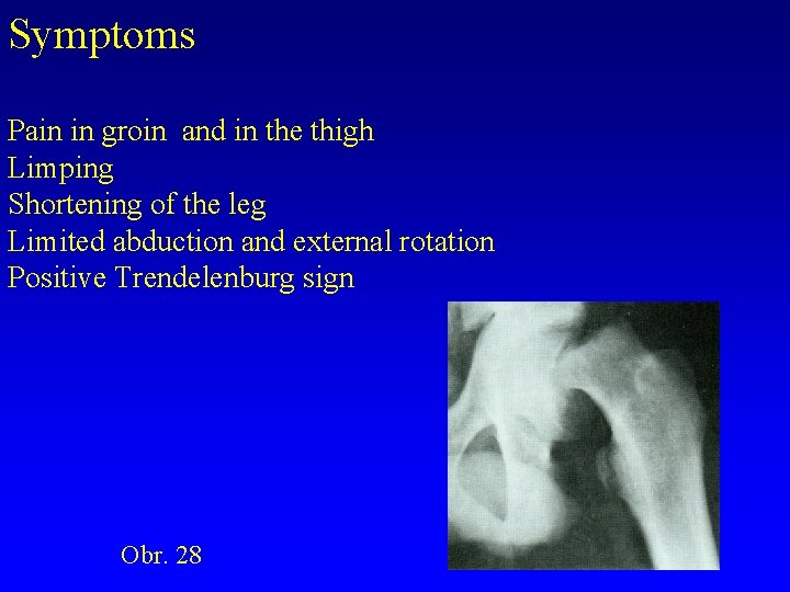 Symptoms Pain in groin and in the thigh Limping Shortening of the leg Limited