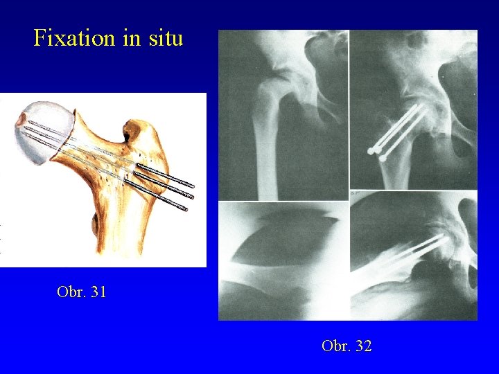 Fixation in situ Obr. 31 Obr. 32 Fixation in situ Obr. 31 Obr. 32