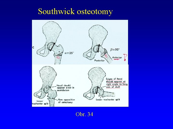 Southwick osteotomy Obr. 34 