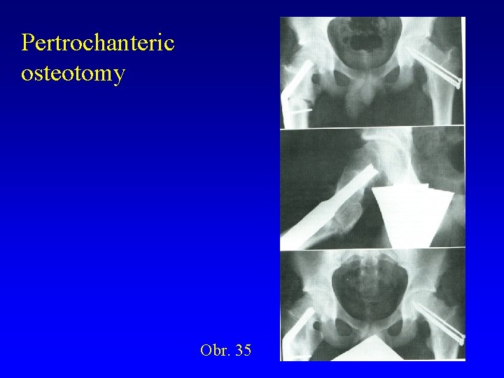 Pertrochanteric osteotomy Obr. 35 