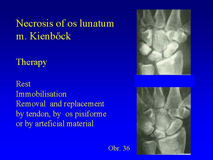 Necrosis of os lunatum m. Kienbőck Therapy Rest Immobilisation Removal and replacement by tendon,