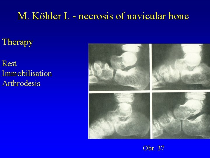 M. Köhler I. - necrosis of navicular bone Therapy Rest Immobilisation Arthrodesis Obr. 37