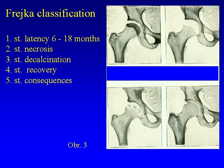 Frejka classification 1. st. latency 6 - 18 months 2. st. necrosis 3. st.