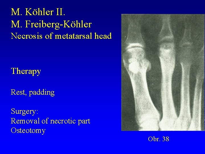 M. Köhler II. M. Freiberg-Köhler Necrosis of metatarsal head Therapy Rest, padding Surgery: Removal