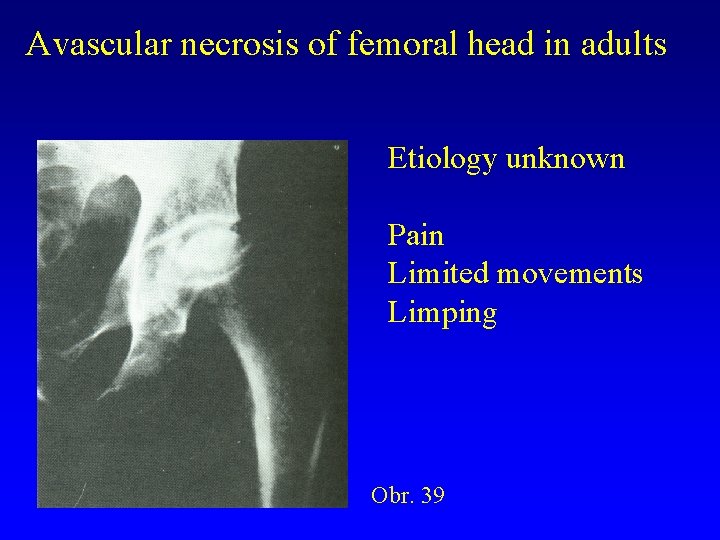 Avascular necrosis of femoral head in adults Etiology unknown Pain Limited movements Limping Obr.