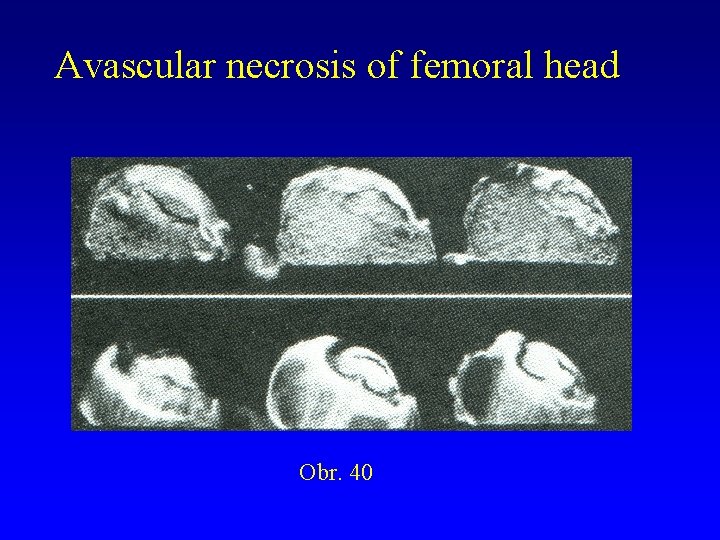 Avascular necrosis of femoral head Obr. 40 