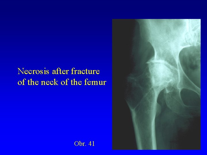 Necrosis after fracture of the neck of the femur Obr. 41 