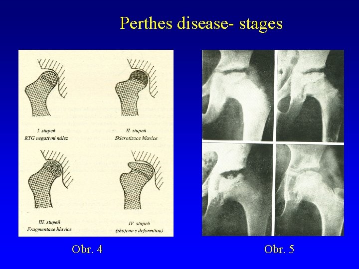 Perthes disease- stages Obr. 4 Obr. 5 