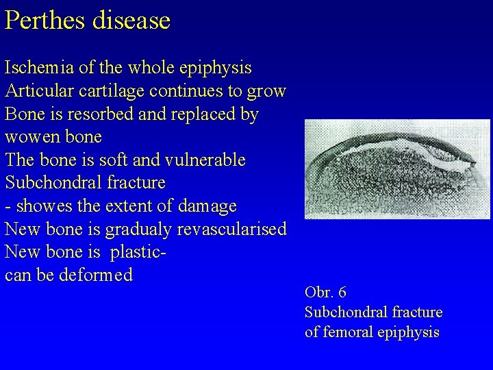 Perthes disease Ischemia of the whole epiphysis Articular cartilage continues to grow Bone is Perthes disease Ischemia of the whole epiphysis Articular cartilage continues to grow Bone is