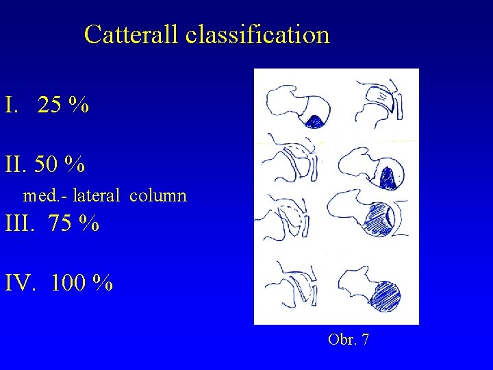 Catterall classification I. 25 % II. 50 % med. - lateral column III. 75