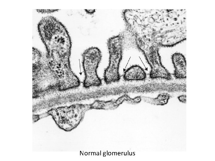 Normal glomerulus 