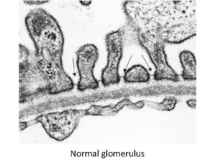 Normal glomerulus 