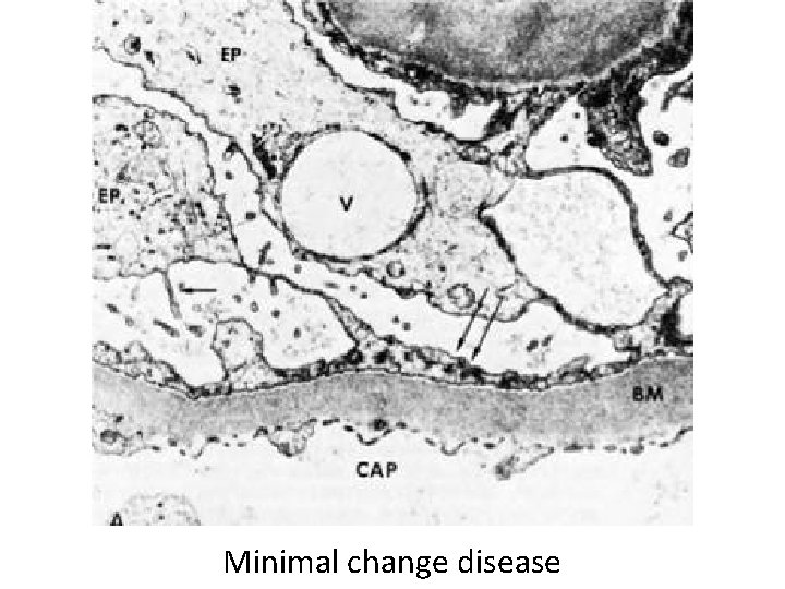 Minimal change disease 
