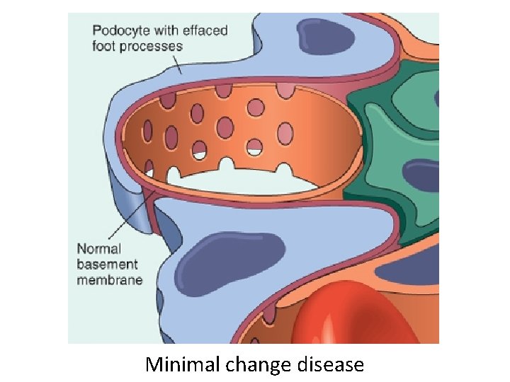 Minimal change disease 