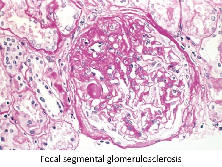 Focal segmental glomerulosclerosis 