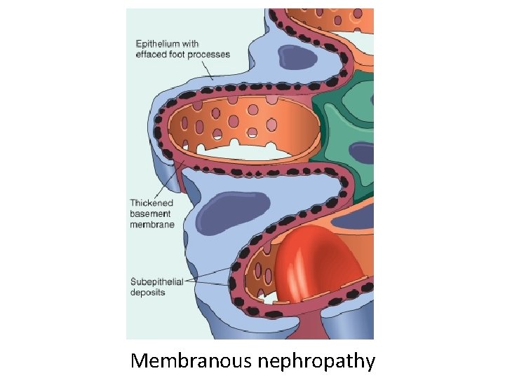 Membranous nephropathy 