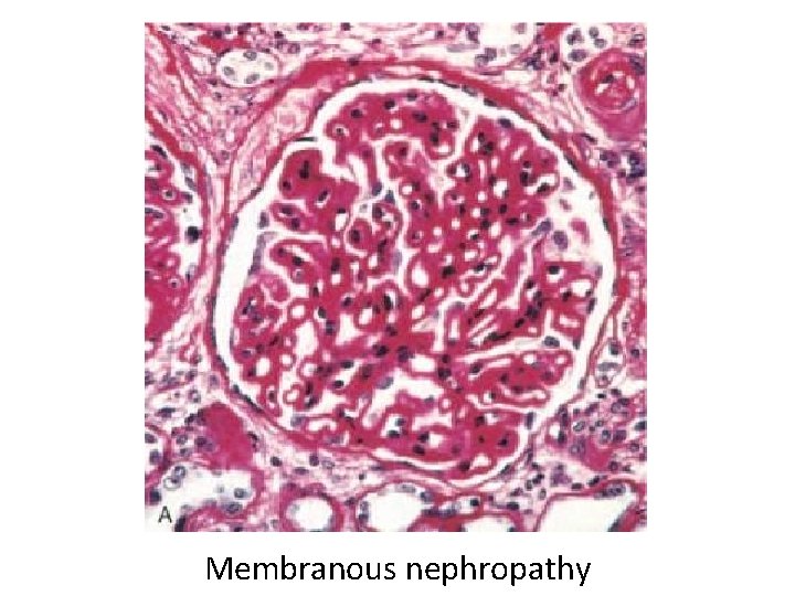 Membranous nephropathy 