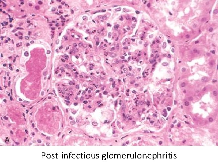 Post-infectious glomerulonephritis 