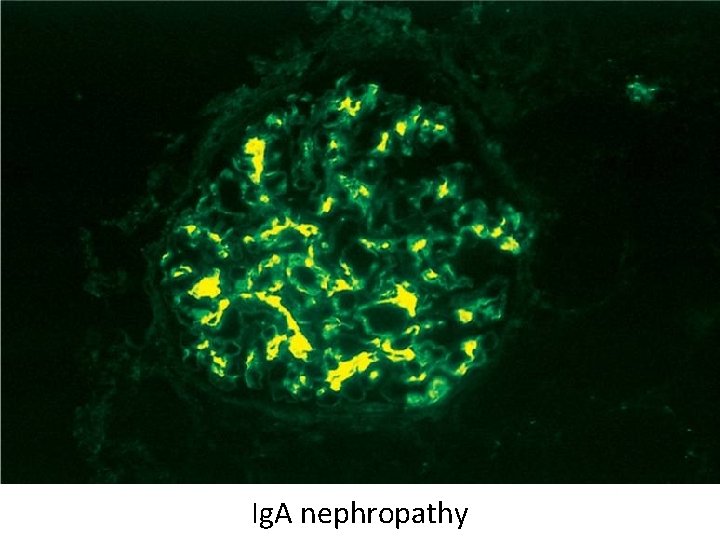 Ig. A nephropathy 