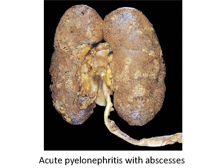 Acute pyelonephritis with abscesses 