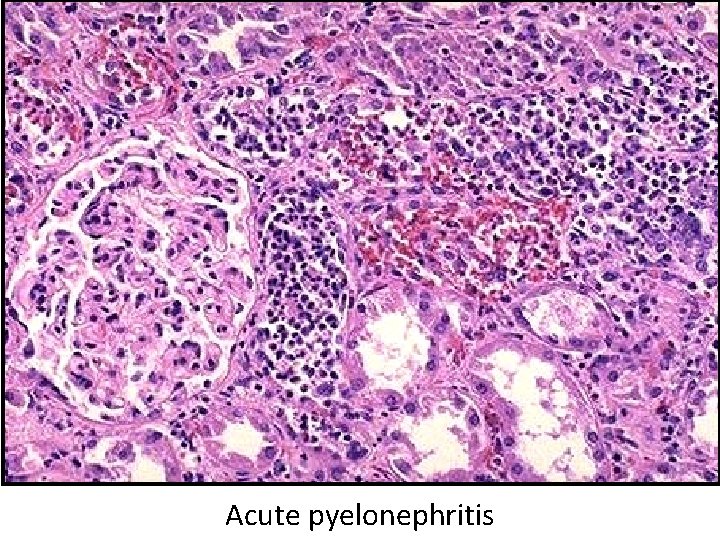 Acute pyelonephritis 