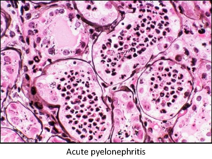 Acute pyelonephritis 