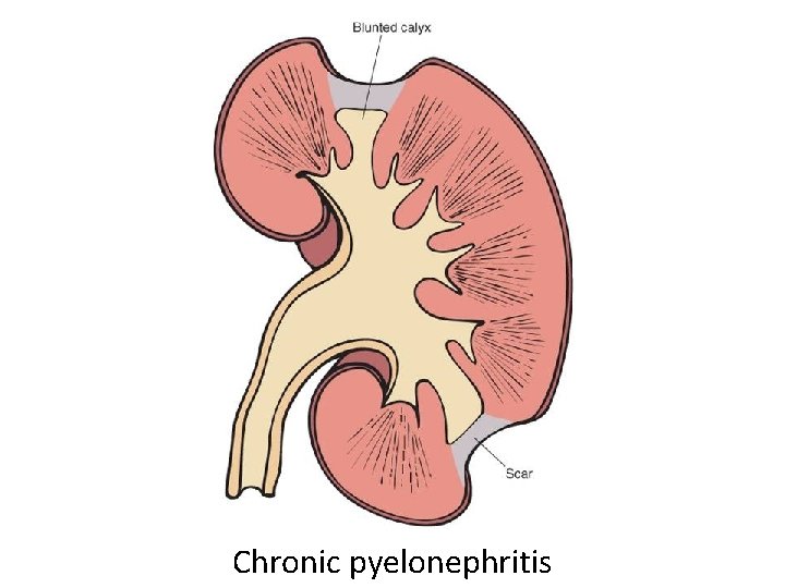 Chronic pyelonephritis 