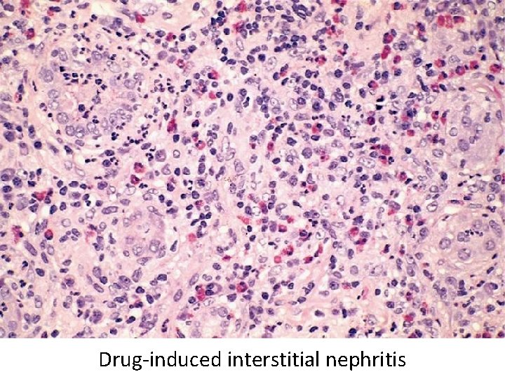 Drug-induced interstitial nephritis 