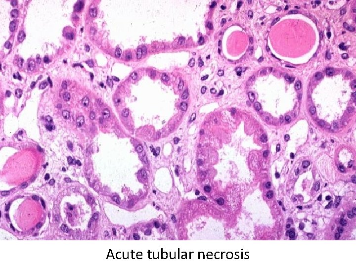 Acute tubular necrosis 