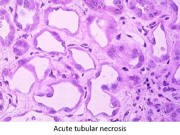 Acute tubular necrosis 