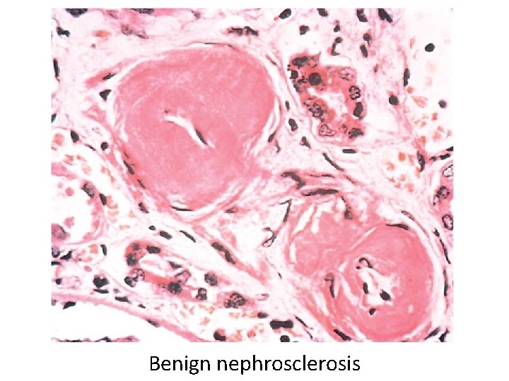 Benign nephrosclerosis 