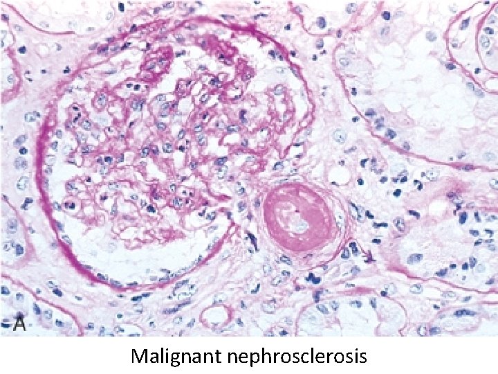 Malignant nephrosclerosis 