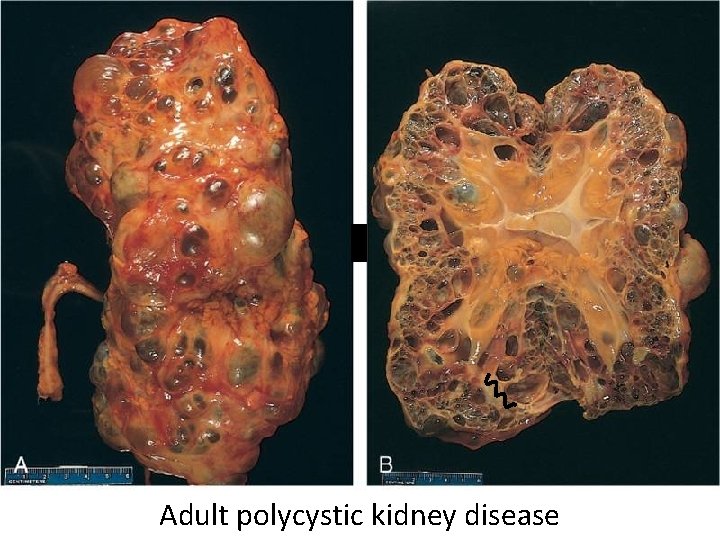 Adult polycystic kidney disease 