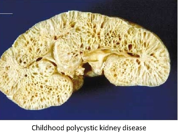 Childhood polycystic kidney disease 