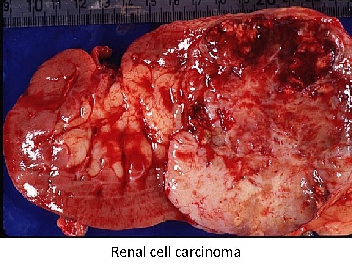 Renal cell carcinoma 