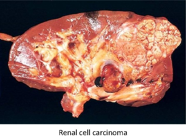 Renal cell carcinoma 