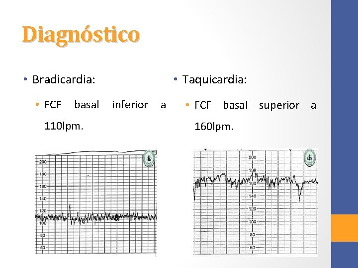 Diagnóstico • Taquicardia: • Bradicardia: • FCF basal 110 lpm. inferior a • FCF