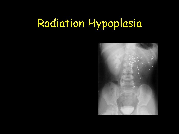 Radiation Hypoplasia 