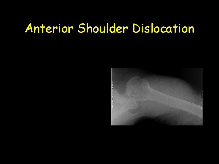 Anterior Shoulder Dislocation 