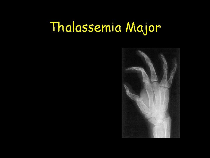 Thalassemia Major 