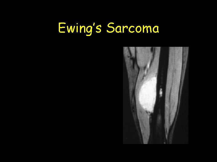 Ewing’s Sarcoma 