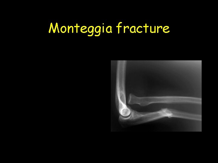 Monteggia fracture 