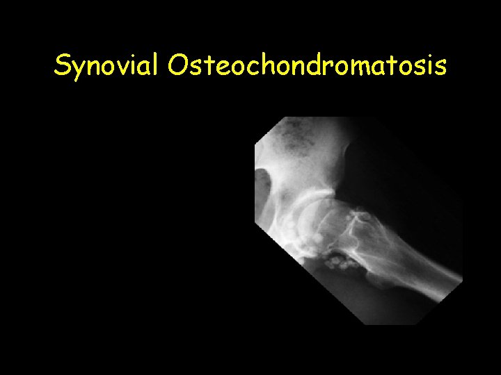 Synovial Osteochondromatosis 