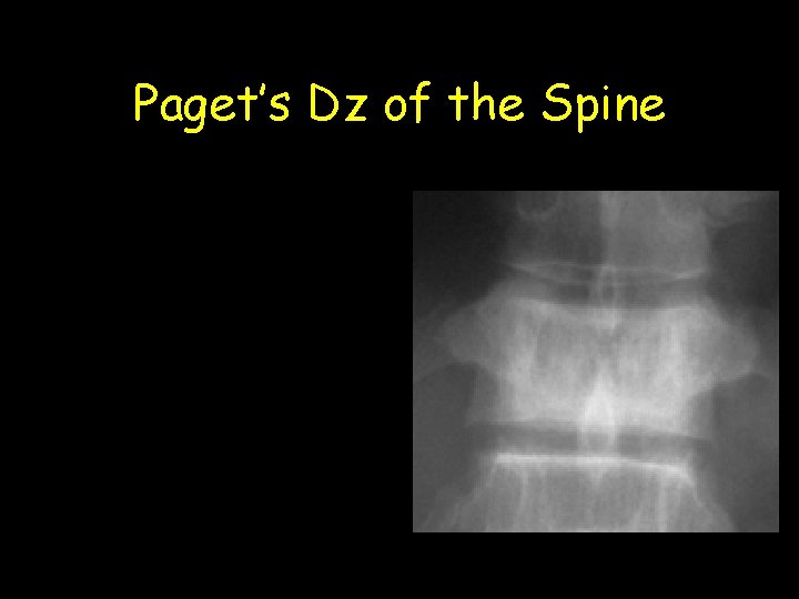 Paget’s Dz of the Spine 