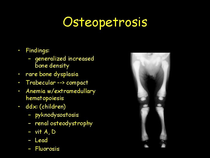 Osteopetrosis • Findings: – generalized increased bone density • rare bone dysplasia • Trabecular