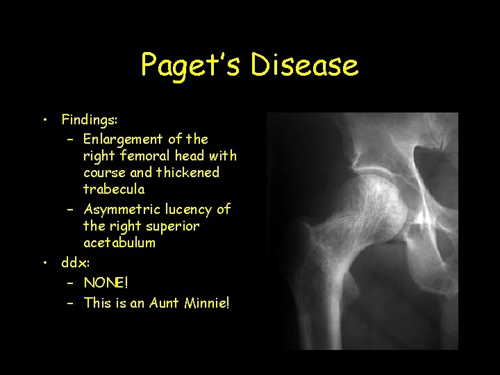 Paget’s Disease • Findings: – Enlargement of the right femoral head with course and