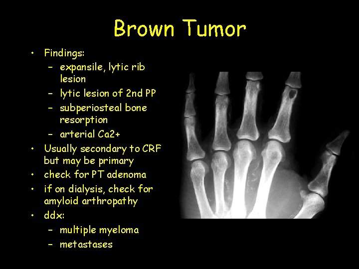 Brown Tumor • Findings: – expansile, lytic rib lesion – lytic lesion of 2